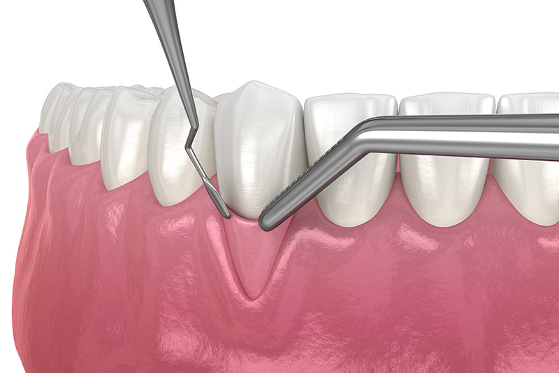 Bone Grafting / Bone Augmentation in Culver City