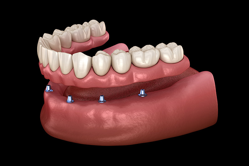 Implant Dentures in Culver City