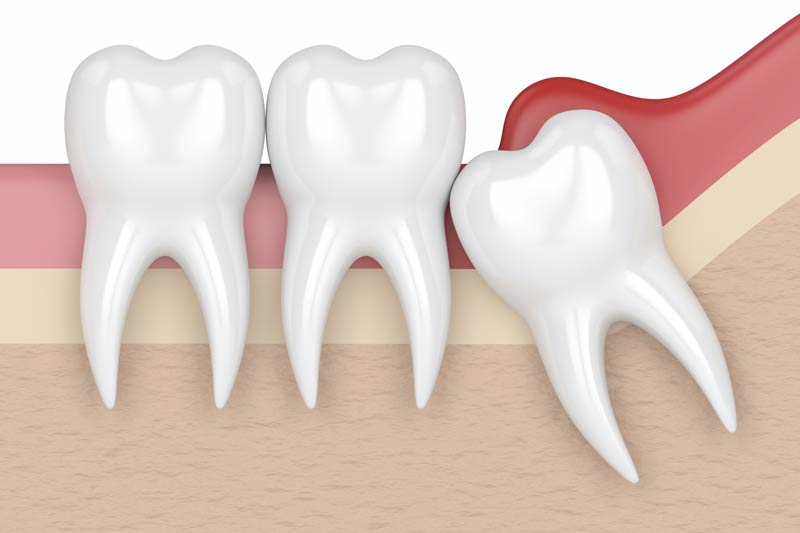 Wisdom Tooth Removal in Culver City